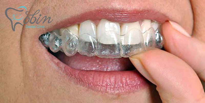 عوامل تاثیرگذار در هزینه ارتودنسی دندان